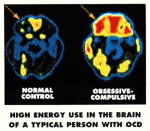 OCD: Alternative to meds…